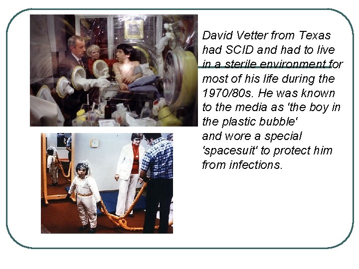 David Vetter from Texas had SCID and had to live in a sterile environment