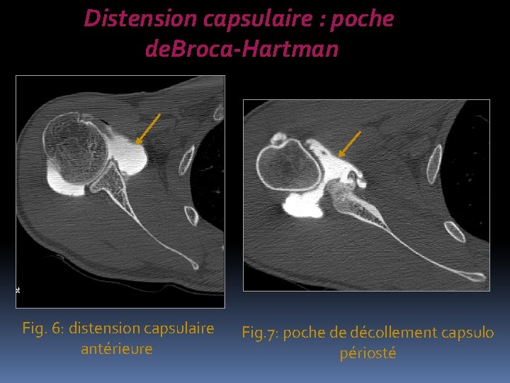 Distension capsulaire : poche de. Broca-Hartman Fig. 6: distension capsulaire antérieure Fig. 7: poche