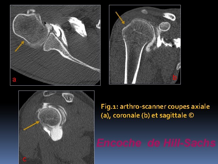 b a Fig. 1: arthro-scanner coupes axiale (a), coronale (b) et sagittale © Encoche
