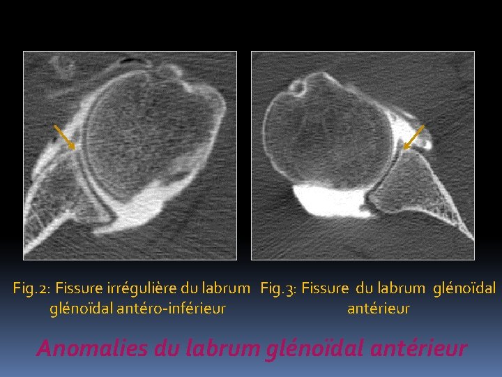 Fig. 2: Fissure irrégulière du labrum Fig. 3: Fissure du labrum glénoïdal antéro-inférieur antérieur