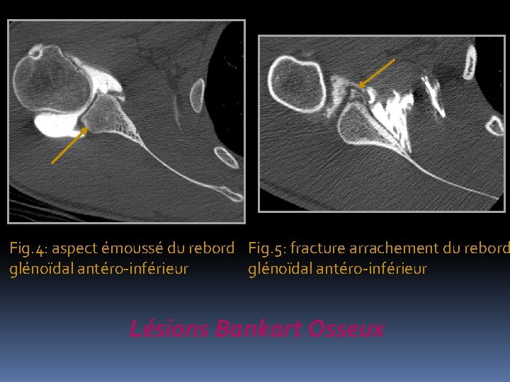 Fig. 4: aspect émoussé du rebord Fig. 5: fracture arrachement du rebord glénoïdal antéro-inférieur