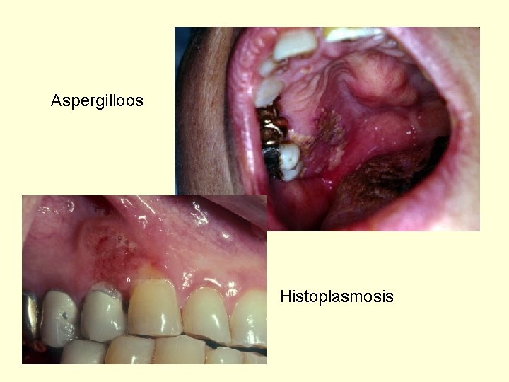 Aspergilloos Histoplasmosis 