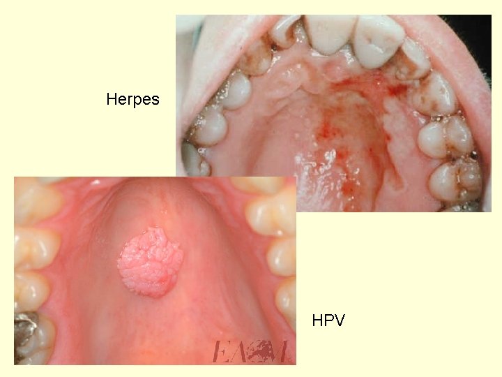 Herpes HPV 