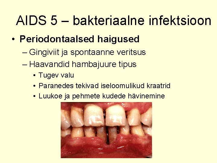 AIDS 5 – bakteriaalne infektsioon • Periodontaalsed haigused – Gingiviit ja spontaanne veritsus –