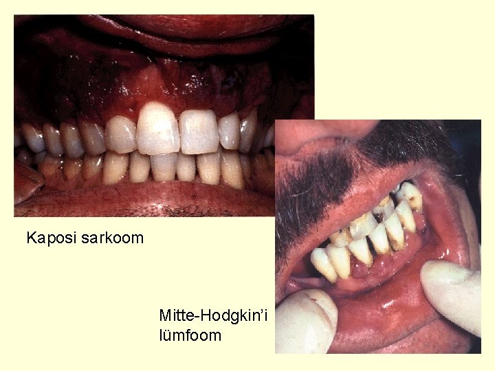 Kaposi sarkoom Mitte-Hodgkin’i lümfoom 