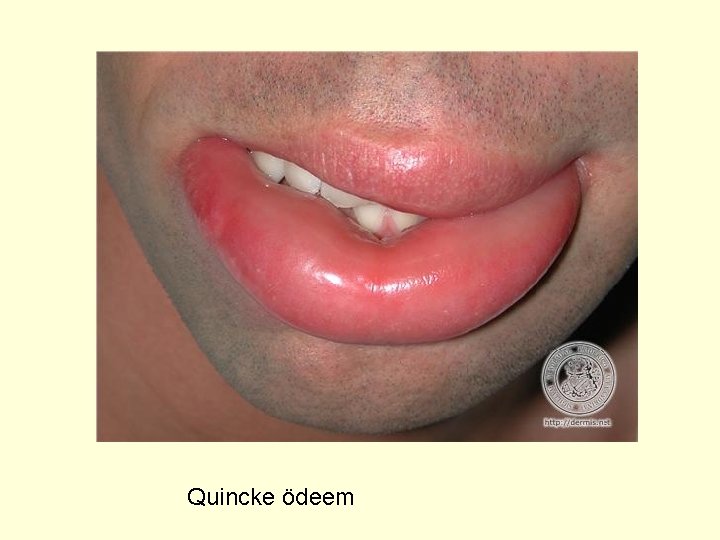 Quincke ödeem 