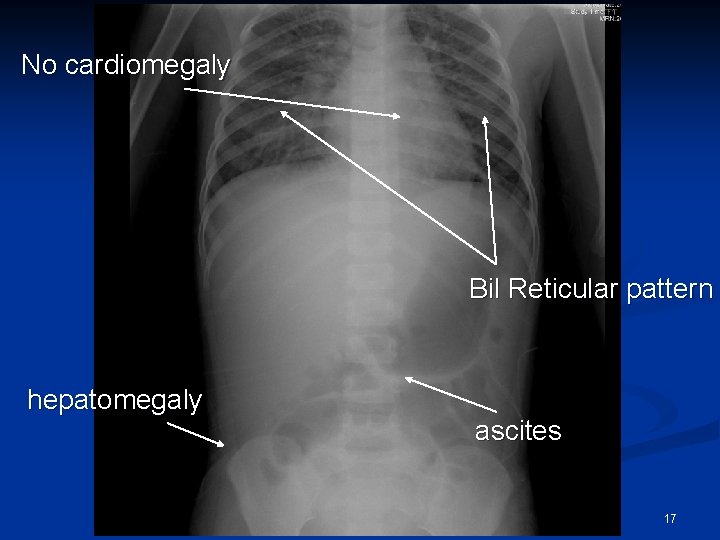 No cardiomegaly Bil Reticular pattern hepatomegaly ascites 17 