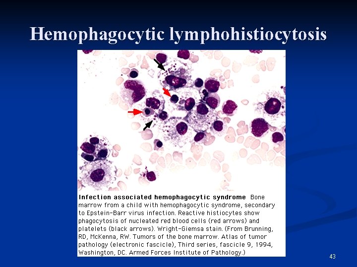 Hemophagocytic lymphohistiocytosis 43 