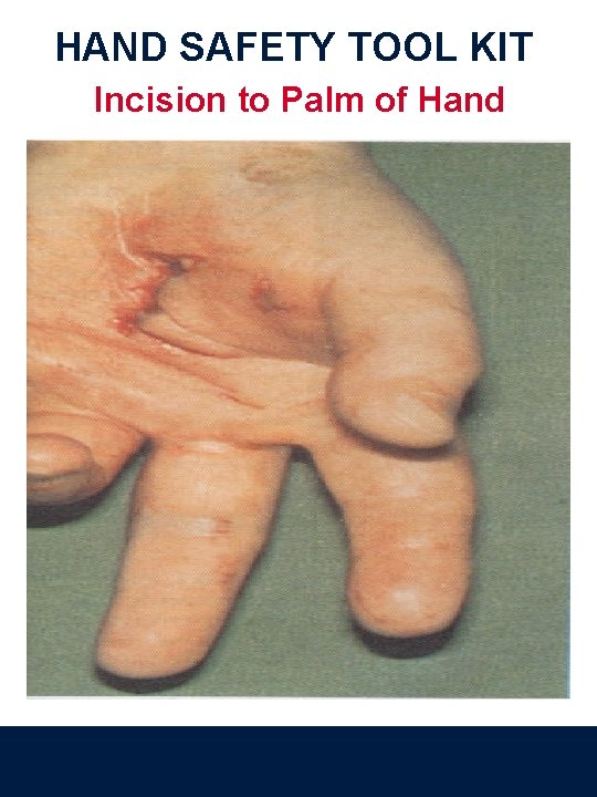 HAND SAFETY TOOL KIT Incision to Palm of Hand 