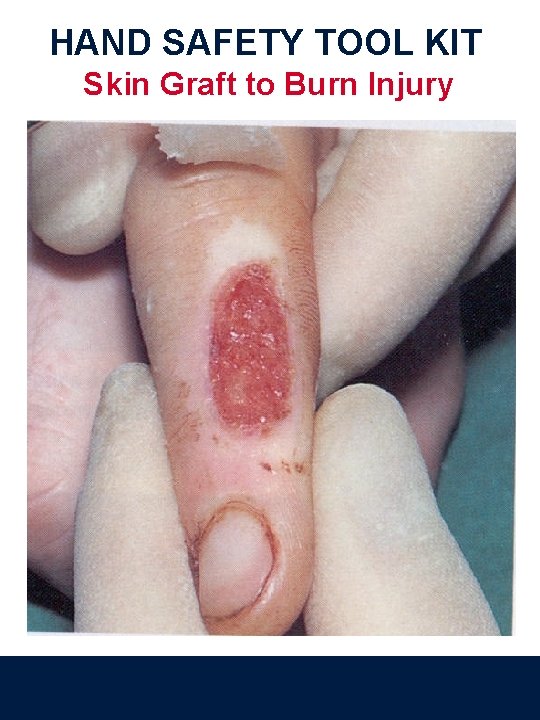 HAND SAFETY TOOL KIT Skin Graft to Burn Injury 