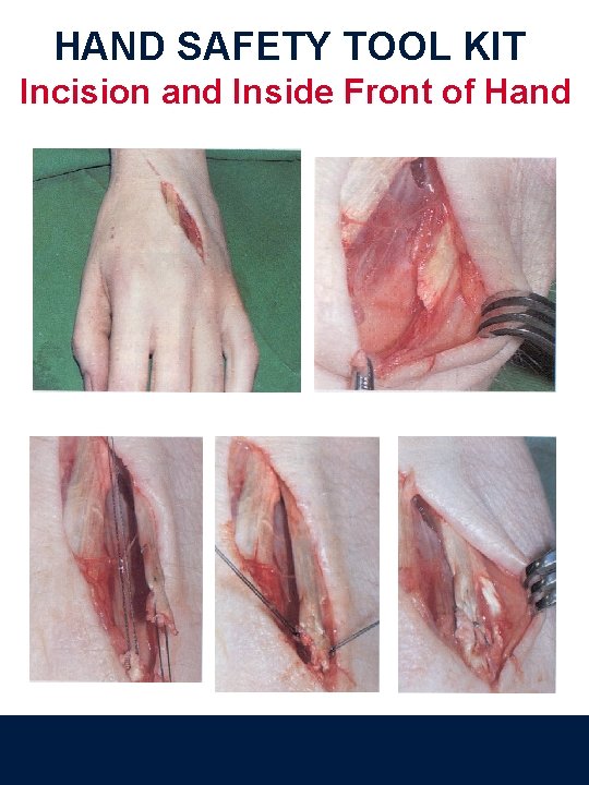 HAND SAFETY TOOL KIT Incision and Inside Front of Hand 