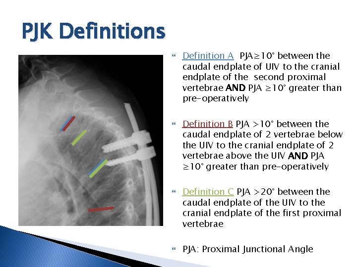 PJK Definitions Definition A PJA≥ 10° between the caudal endplate of UIV to the