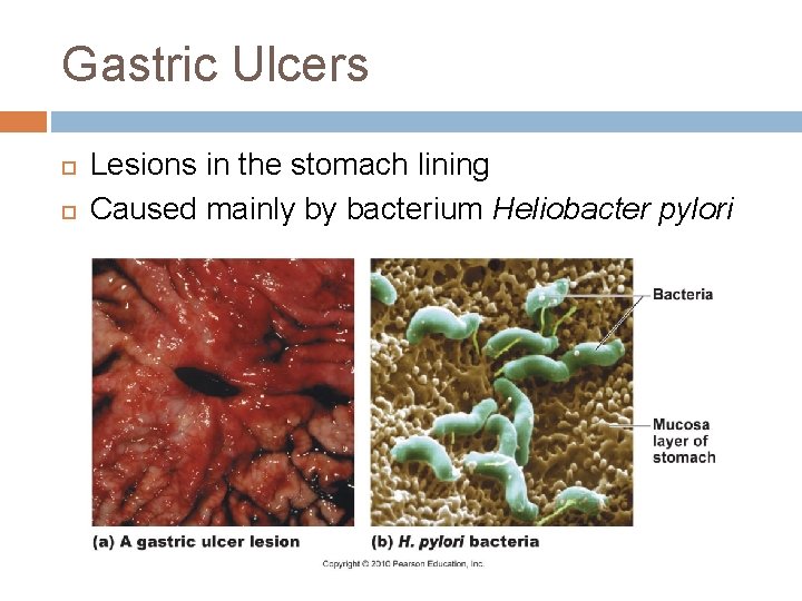 Gastric Ulcers Lesions in the stomach lining Caused mainly by bacterium Heliobacter pylori 