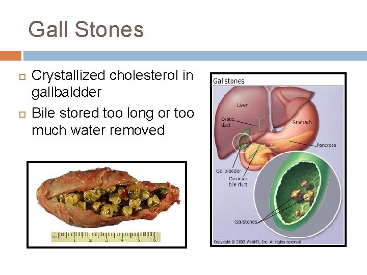 Gall Stones Crystallized cholesterol in gallbaldder Bile stored too long or too much water