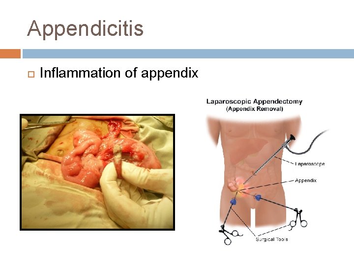 Appendicitis Inflammation of appendix 