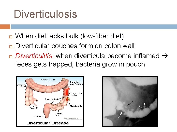 Diverticulosis When diet lacks bulk (low-fiber diet) Diverticula: pouches form on colon wall Diverticulitis: