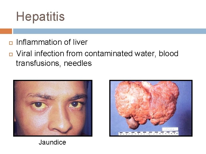 Hepatitis Inflammation of liver Viral infection from contaminated water, blood transfusions, needles Jaundice 