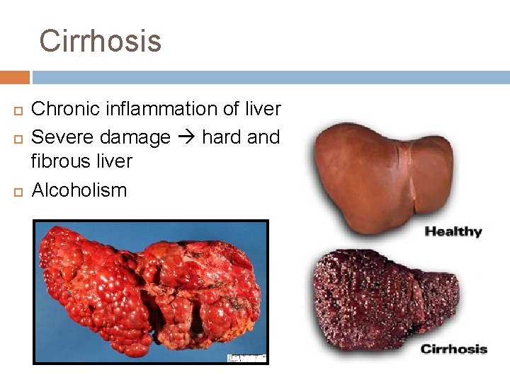 Cirrhosis Chronic inflammation of liver Severe damage hard and fibrous liver Alcoholism 