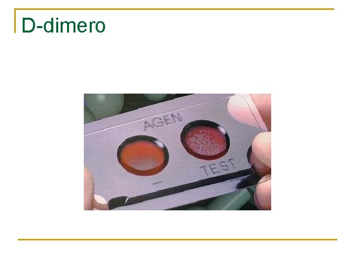D-dimero D-dimero