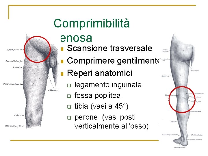 Comprimibilità venosa n n n Scansione trasversale Comprimere gentilmente Reperi anatomici q q legamento