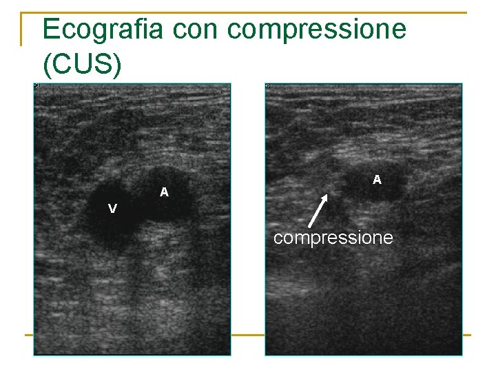 Ecografia con compressione (CUS) A A V compressione 