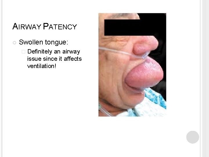 AIRWAY PATENCY Swollen tongue: � Definitely an airway issue since it affects ventilation! AIRWAY PATENCY Swollen tongue: � Definitely an airway issue since it affects ventilation!