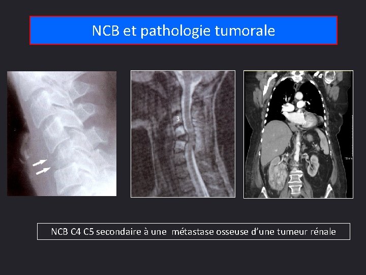 NCB et pathologie tumorale NCB C 4 C 5 secondaire à une métastase osseuse