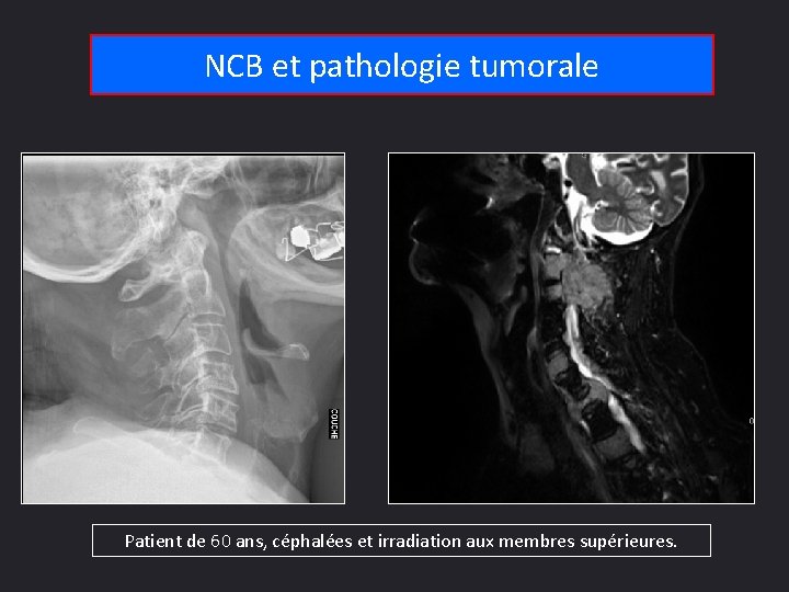 NCB et pathologie tumorale Patient de 60 ans, céphalées et irradiation aux membres supérieures.