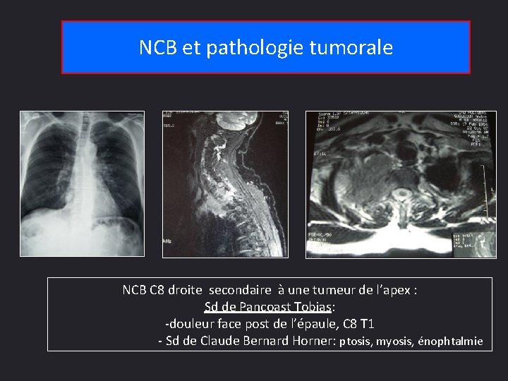 NCB et pathologie tumorale NCB C 8 droite secondaire à une tumeur de l’apex