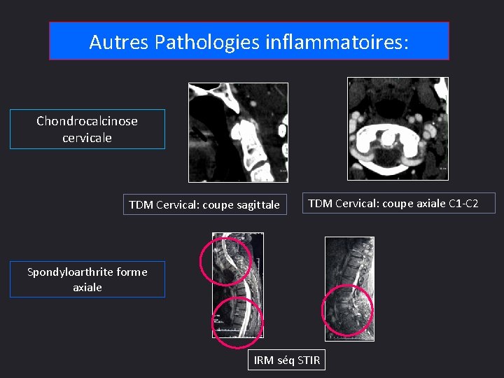 Autres Pathologies inflammatoires: Chondrocalcinose cervicale TDM Cervical: coupe sagittale TDM Cervical: coupe axiale C