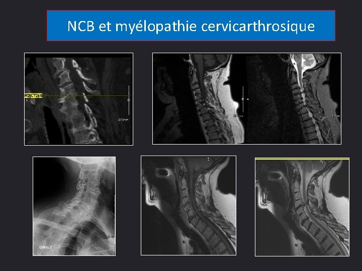 NCB et myélopathie cervicarthrosique 