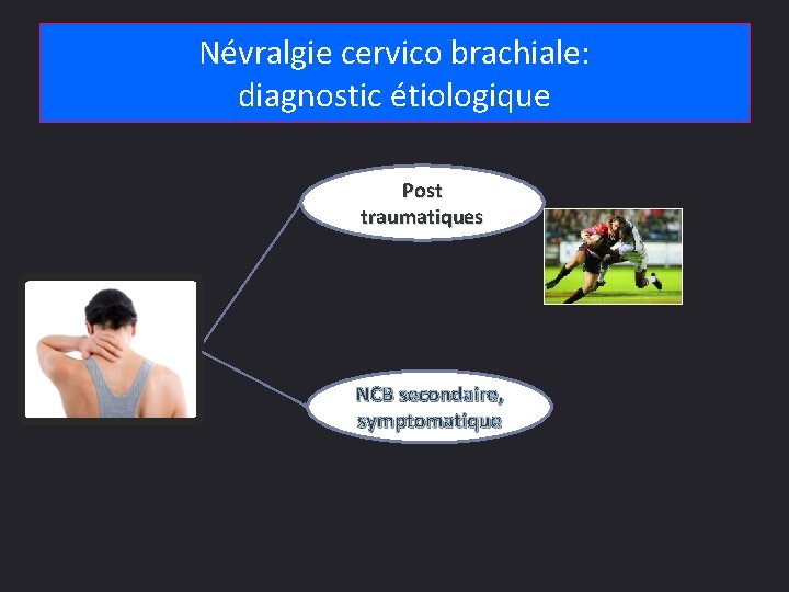 Névralgie cervico brachiale: diagnostic étiologique Post traumatiques NCB secondaire, symptomatique 