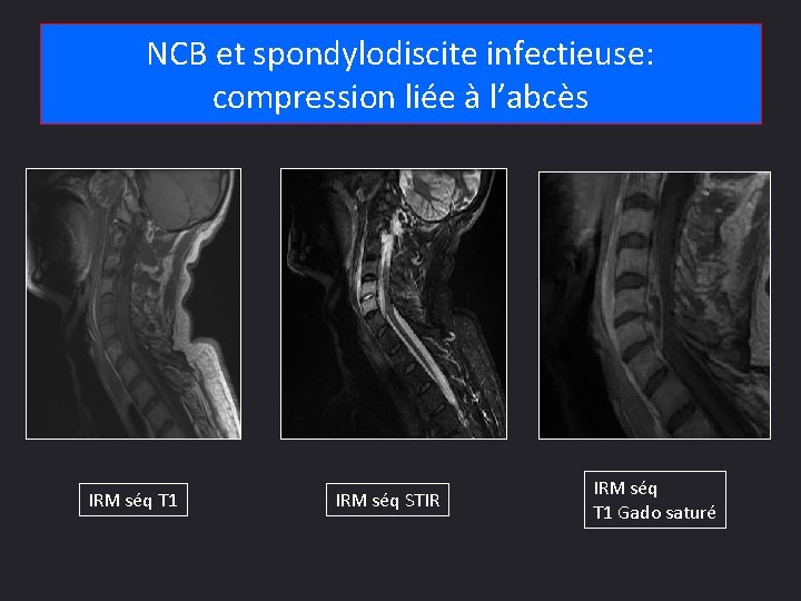NCB et spondylodiscite infectieuse: compression liée à l’abcès IRM séq T 1 IRM séq