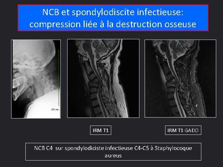 NCB et spondylodiscite infectieuse: compression liée à la destruction osseuse • IRM T 1