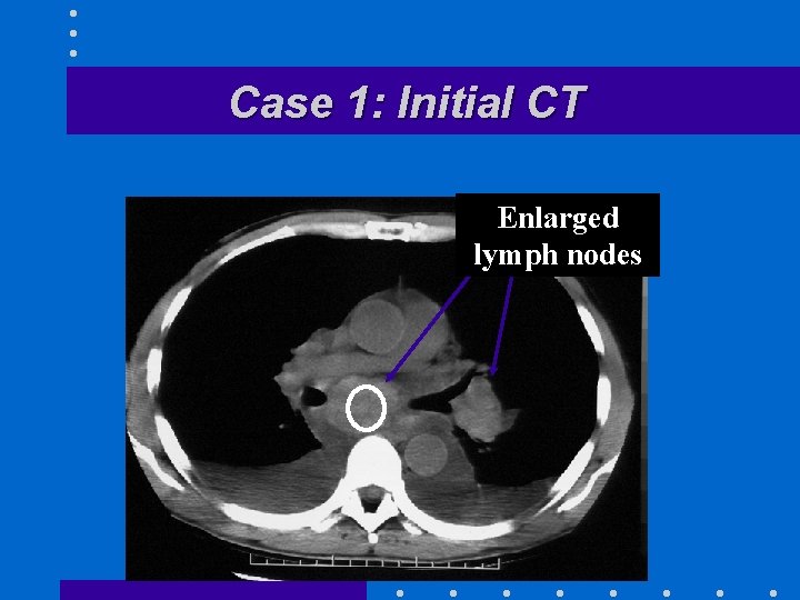 Case 1: Initial CT Enlarged lymph nodes 