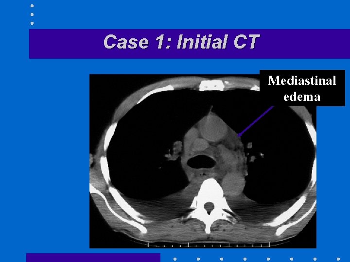 Case 1: Initial CT Mediastinal edema 