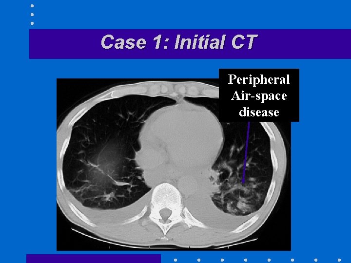 Case 1: Initial CT Peripheral Air-space disease 