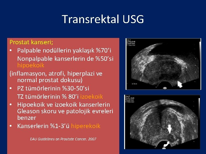Transrektal USG Prostat kanseri; • Palpable nodüllerin yaklaşık %70’i Nonpalpable kanserlerin de %50’si hipoekoik