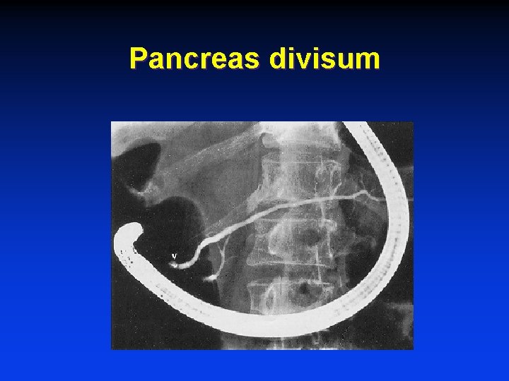Pancreas divisum 