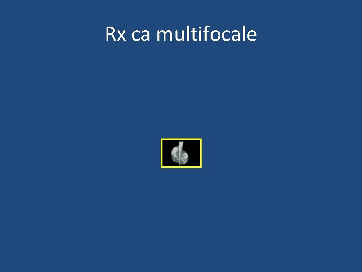 Rx ca multifocale 