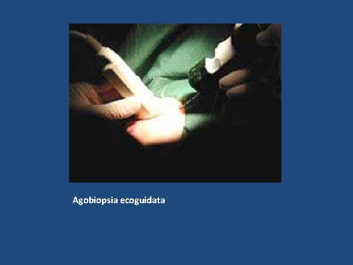 Agobiopsia ecoguidata 