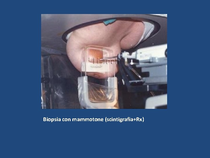 Biopsia con mammotone (scintigrafia+Rx) 