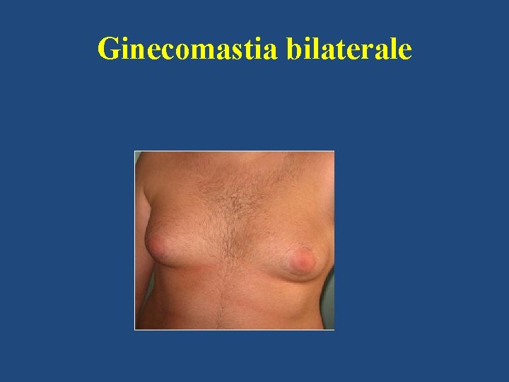 Ginecomastia bilaterale 