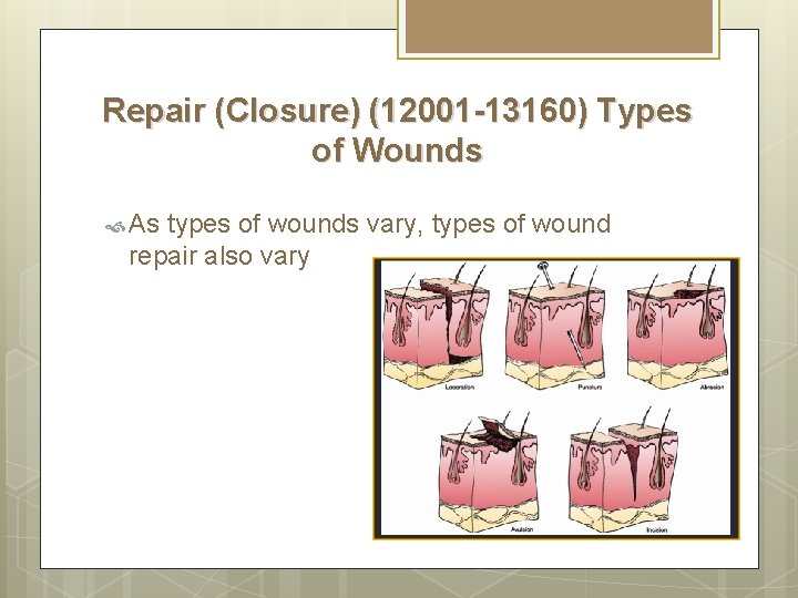 Repair (Closure) (12001 -13160) Types of Wounds As types of wounds vary, types of