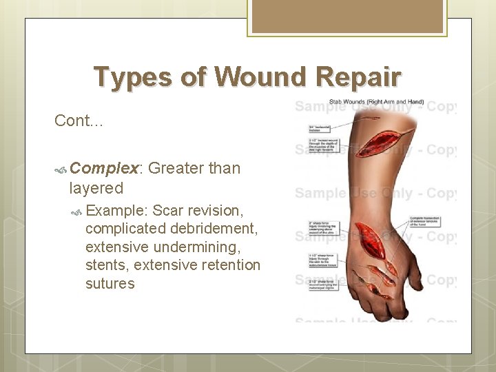 Types of Wound Repair Cont… Complex: Greater than layered Example: Scar revision, complicated debridement,