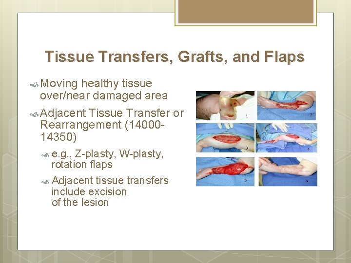 Tissue Transfers, Grafts, and Flaps Moving healthy tissue over/near damaged area Adjacent Tissue Transfer