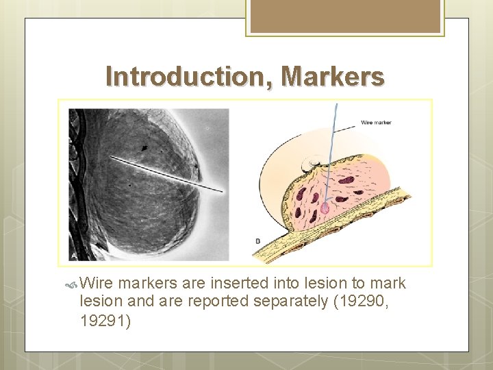 Introduction, Markers Wire markers are inserted into lesion to mark lesion and are reported