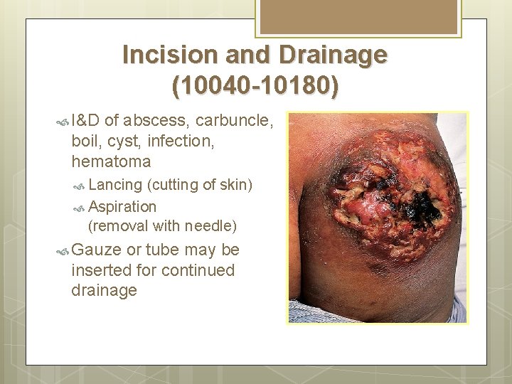 Incision and Drainage (10040 -10180) I&D of abscess, carbuncle, boil, cyst, infection, hematoma Lancing