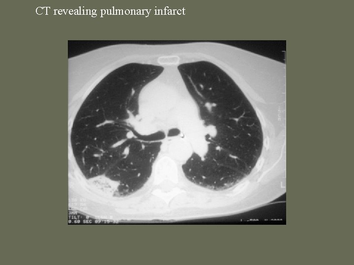 CT revealing pulmonary infarct 