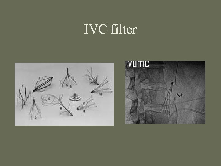 IVC filter 